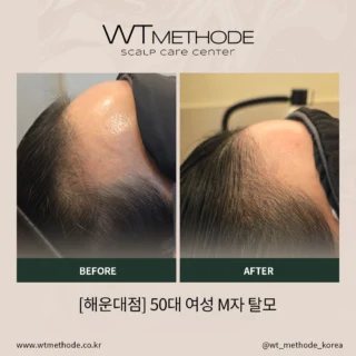 두피·탈모관리 전후 사례 1