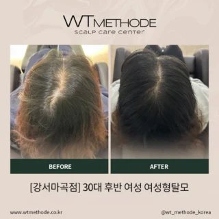 두피·탈모관리 전후 사례 2