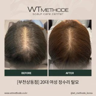 두피·탈모관리 전후 사례 3