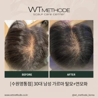 두피·탈모관리 전후 사례 4