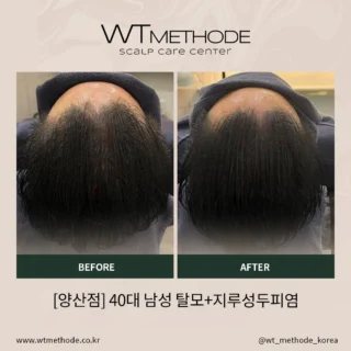 두피·탈모관리 전후 사례 6